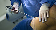 Liposuction Surgery Cost in India