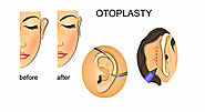 Otoplasty Cost in Delhi