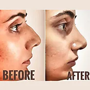 How Long Does a Nose Job Take to Heal?