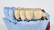 Bridging the Gap: How Crowns Are Used in Dental Bridges