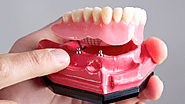 Exploring the Latest Advances in Denture Implant Technology