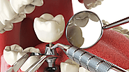 The Role of Tooth Implants in Preventing Adjacent Teeth Shifting