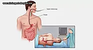 Everything You Need To Know About Endoscopy - Mission Gastro Hospital