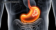 Early Warning Signs Of Stomach Cancer