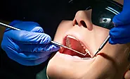 Dental Crowns London - Dental Crowns Cost UK