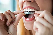 Invisalign Offer London – Invisalign Treatment Cost UK