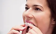 Invisalign Moderate – Invisalign Moderate Package Cost