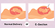 Which delivery is better: Normal Delivery or Cesarean (C-Section) Delivery? - Yashoda Hospital