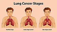 A complete guide to learn everything about lung cancer - Yashoda Hospital