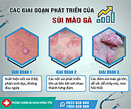 Sùi mào gà có mấy giai đoạn?