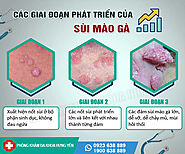 Thời gian ủ bệnh của sùi mào gà là bao lâu?