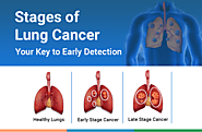 Stages of Lung Cancer: Your Key to Early Detection