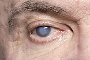 Cataracts (Motiyabind): Types, Causes, Sign, Symptoms, Risk Factors