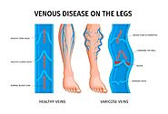 What do you understand by varicose veins ?