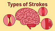 Everything you need to know about Strokes - Yashoda Hospital