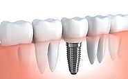 Keep Your Teeth Strong and Healthy by Dental Implant in Tri Nagar
