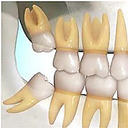Removal of Impacted Teeth, Dental Solutions Delhi