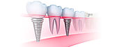 Dental Implant in Delhi - Zenith Skin Dental Clinic