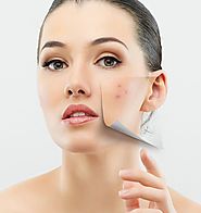 Laser Surgery for Acne Scar