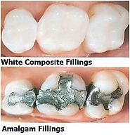 Restoration or Dental Fillings in Delhi