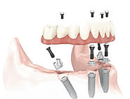 All On 4 Dental Implant