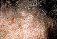 Head lice (pediculosiscapitis)