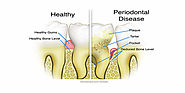 Who Is Most Suitable for Having Dental Implants?