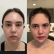 Buccal Fat Removal and Facial Contouring: A Perfect Match