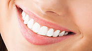 Porcelain Veneers - Greeley Dentals