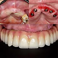 precio dentadura fija sobre 4 implantes precio