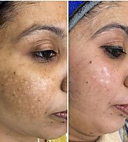 Top Skin Specialist in Chandigarh at Gleuhr