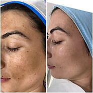 Best Skin Treatment in Chandigarh at Gleuhr