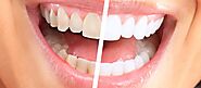 1. Understand Your Whitening Goals