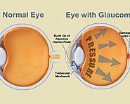 How to Know if you Suffer from Glaucoma?