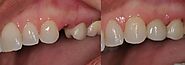 Dental Implants: The Ultimate Solution for Missing Teeth