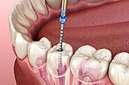 Get the Best RCT Treatment for Pain-Free Dental Care