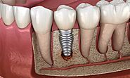 How Dental Implants Improve Oral Health and Confidence