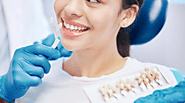 5 Myths About Dental Veneers Debunked