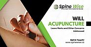 Will Acupuncture Leave Marks and Other Concerns Addressed