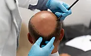 Hair Transplant in Greater Kailash, Delhi | Delhi Wellness clinics