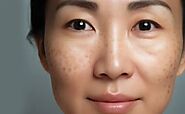 9 Most Commonly Asked Questions About Melasma