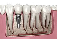 Dental Implants Royal Palm Beach