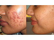 Acne Treatment in Lucknow