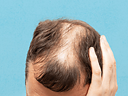 Hair Loss Treatment in Lucknow