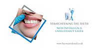 Straightening the teeth with Invisalign is unbelievably easier