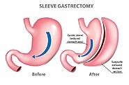 Sleeve Gastrectomy Specialists: Your Guide to Finding the Right Expert