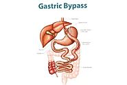 Finding the Best Gastric Bypass Surgeon: A Comprehensive Guide