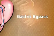 Choosing the Best Gastric Bypass Surgeon: A Comprehensive Guide