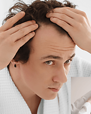 Your Guide to the Best Hair Loss Treatment in Delhi: Expert Solutions That Work