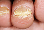 Information on thickened nails, including common causes like fungal infections, and advice on treatment options to re...